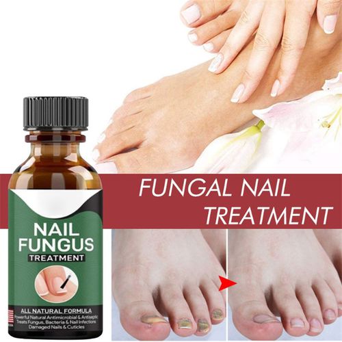 Fast Nail Fungal Treatment