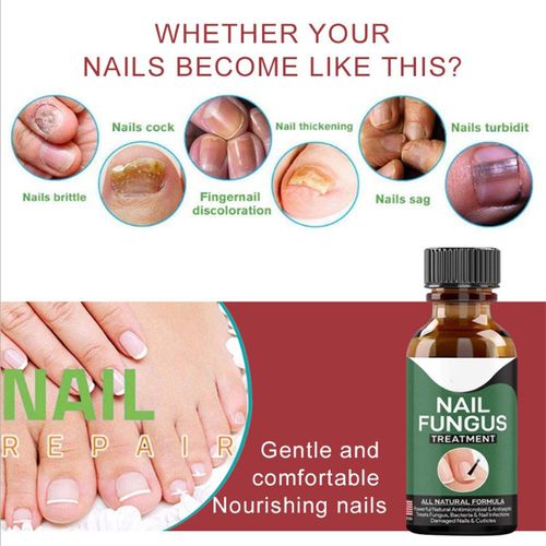 Fast Nail Fungal Treatment